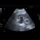 Ureterolithiasis, urolithiasis, hydronephrosis, grade II: US - Ultrasound